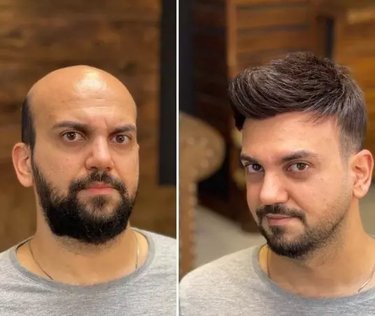 Hair Replacement in Jaipur: A Non-Surgical Way to Get Your Confidence Back