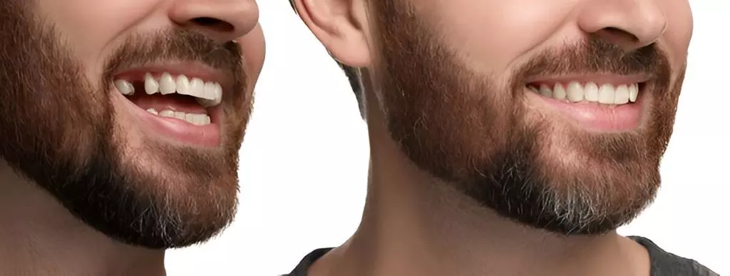 Say Goodbye to Gaps: How Ancaster Dental Implants Change Your Smile Forever