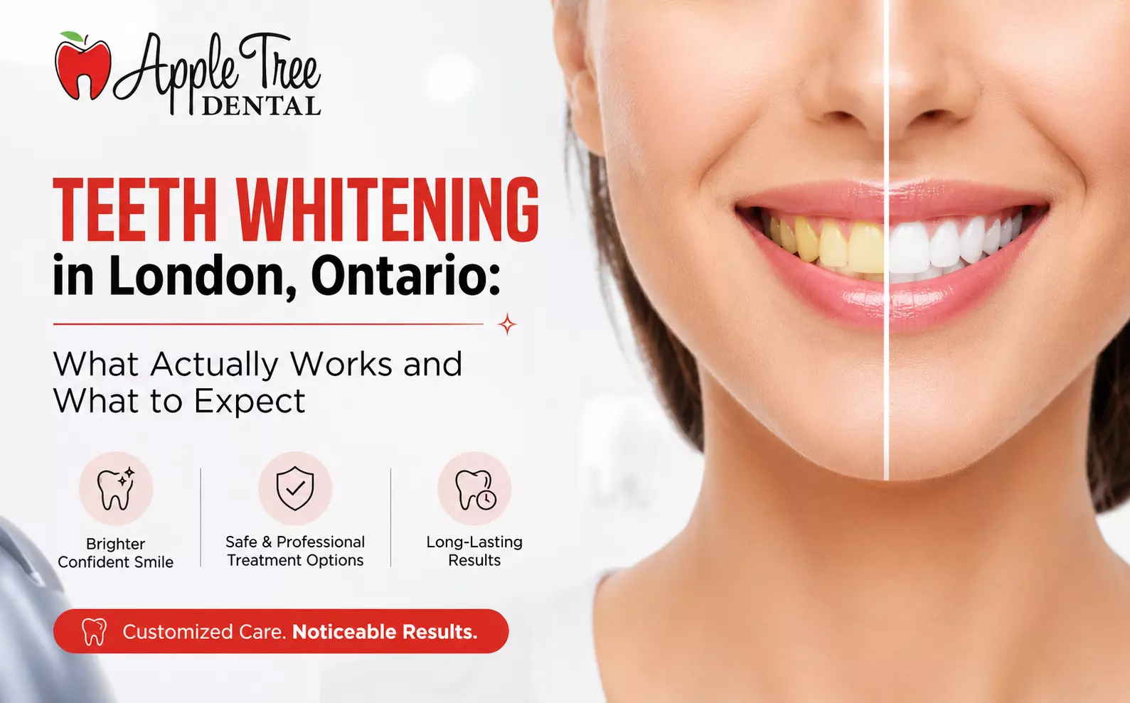 Teeth Whitening in London, Ontario: What Actually Works and What to Expect