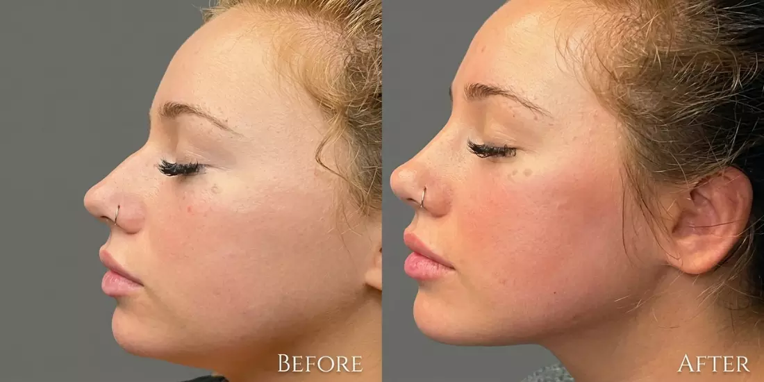 6 Things You Should Know About Jawline Contouring in Mississauga