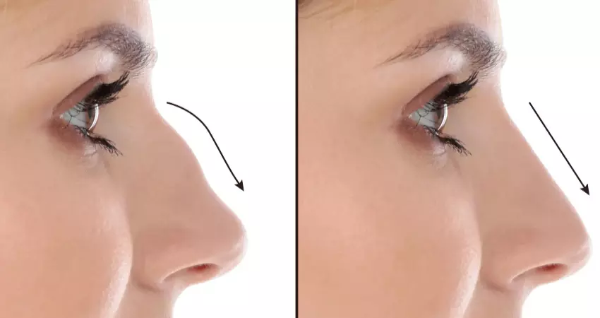 Septoplasty in Dubai: Improving Sleep Through Better Breathing