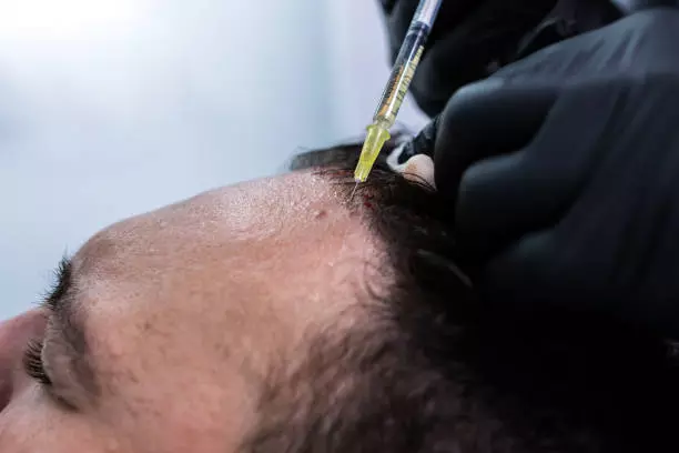 Expert Insights, Innovations, and Patient Experience FUE Hair Transplant: