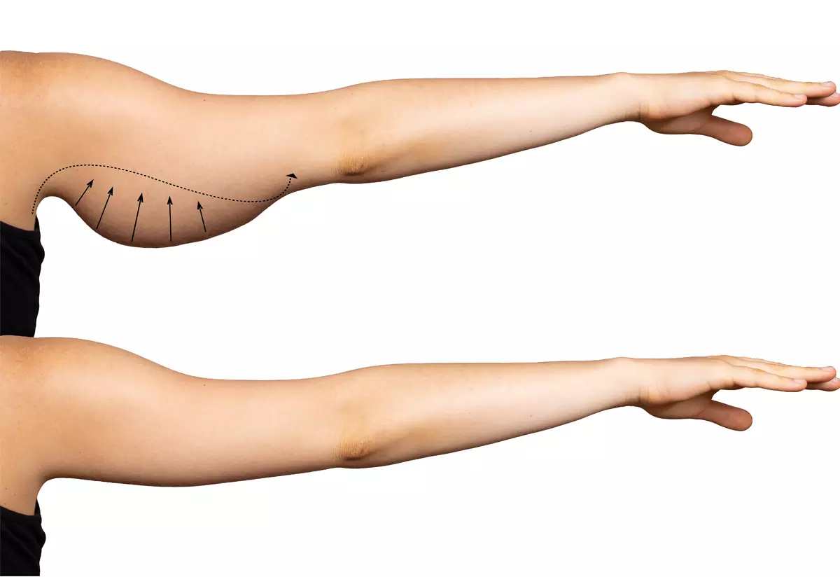 Top Options for Upper Arm Skin Tightening in Islamabad: Surgical and Non-Surgical