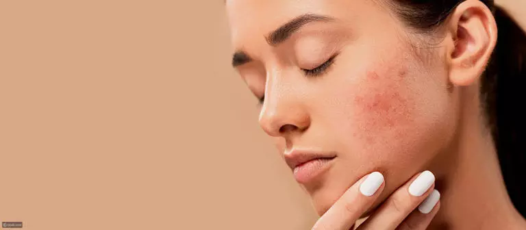 The Complete Guide to Acne Treatment: Expert Medical’s Proven Methods for Healthy Skin