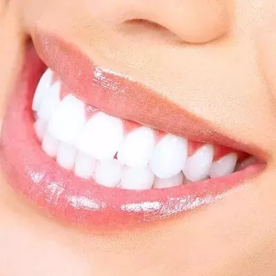 How Does Laser Teeth Whitening Work?