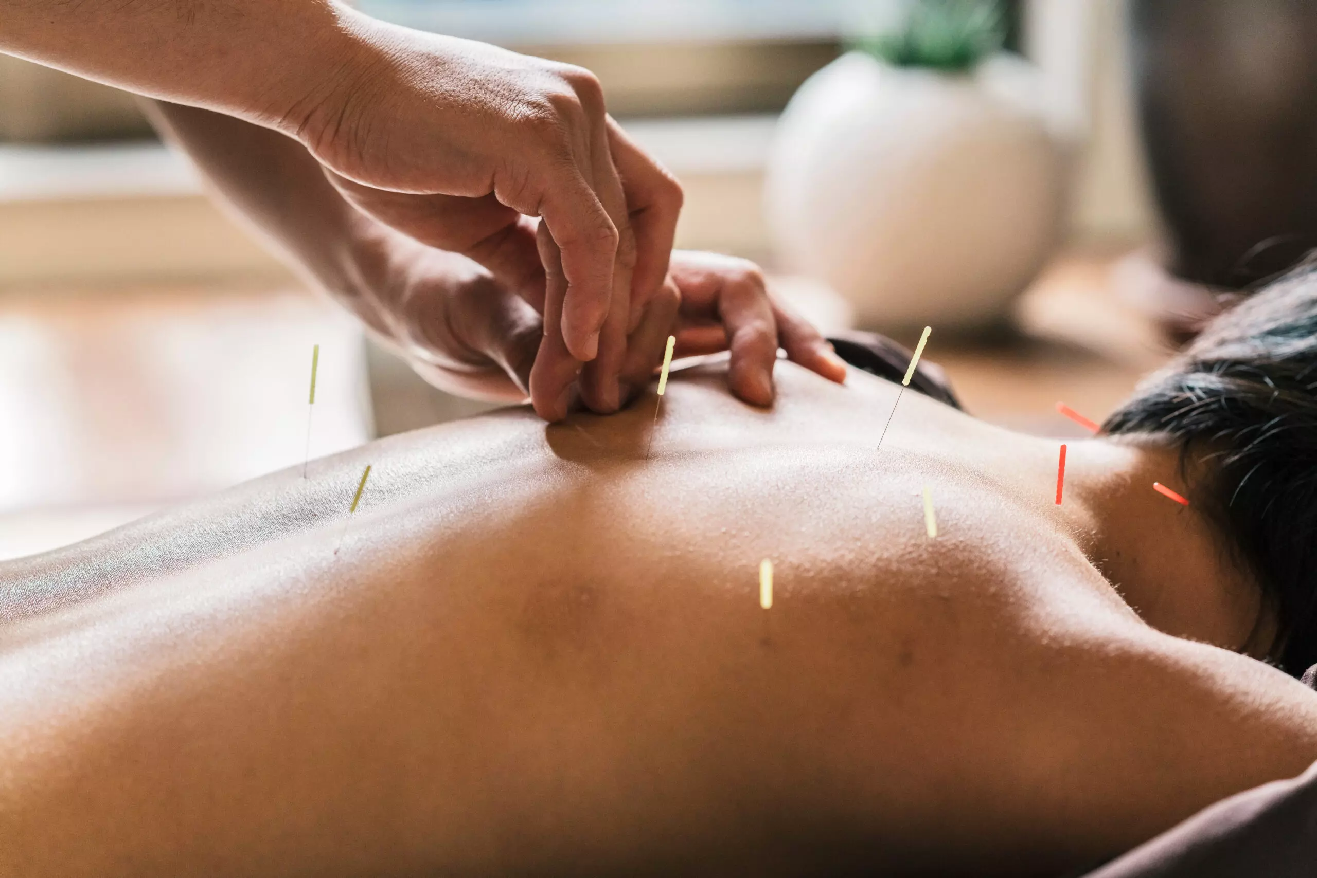 Best Acupuncture in Reston for Back Pain, Migraines & Stress
