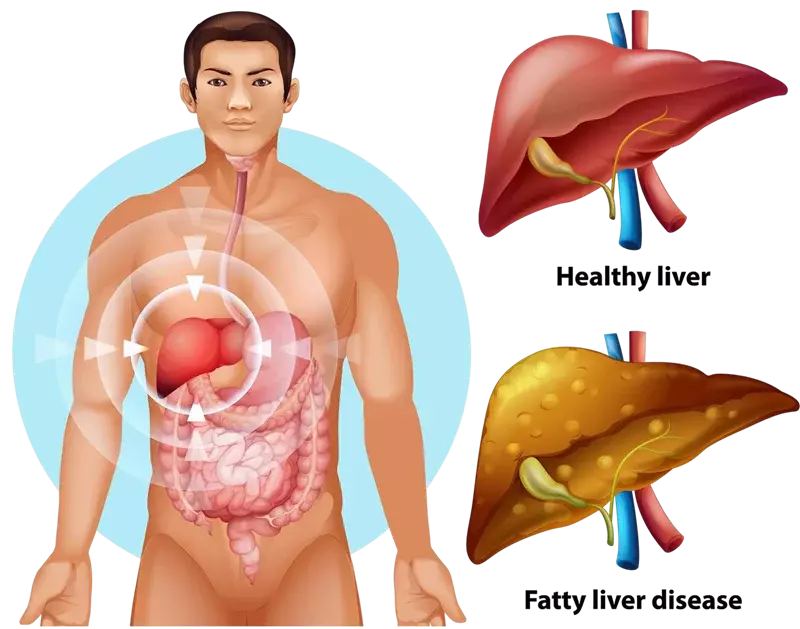 Ayurvedic Treatment For Cirrhosis of Liver: A Holistic Recovery Path