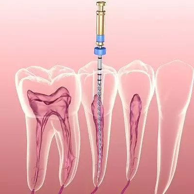 The Complete Guide to Modern Root Canal Procedures