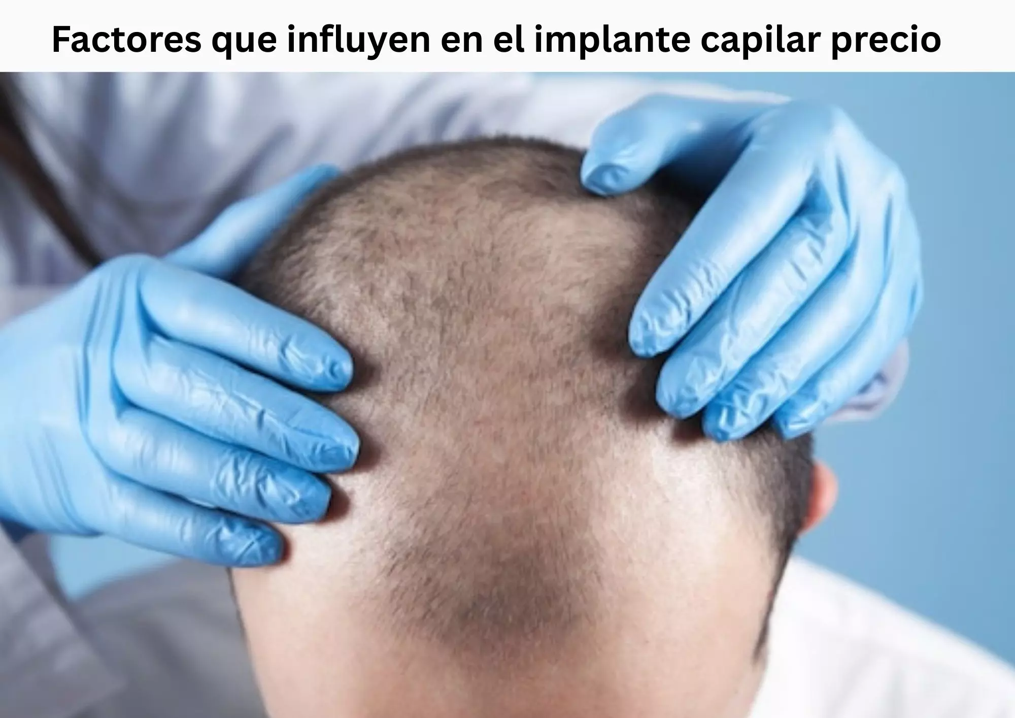 Factores que influyen en el implante capilar precio