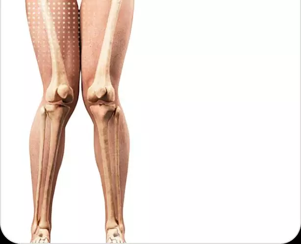 Knock Knees Treatment: Meera's Journey to Better Mobility with Sobti Ortho