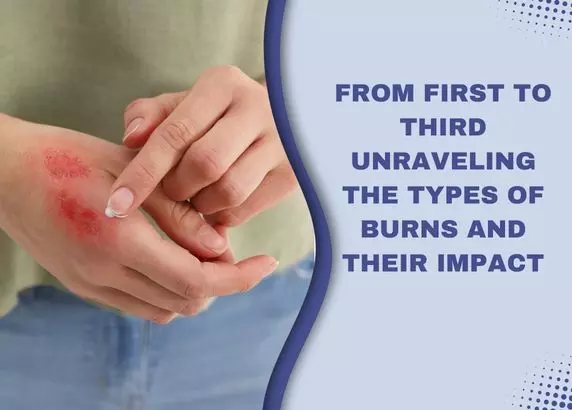 Fast-Acting Burn Treatment Tips for Immediate Care