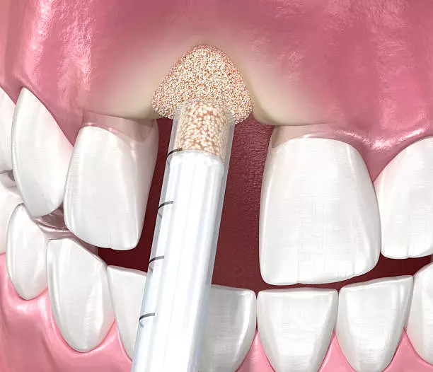 Restore Gum Strength and Smile Confidence Gum Grafting in Islamabad:
