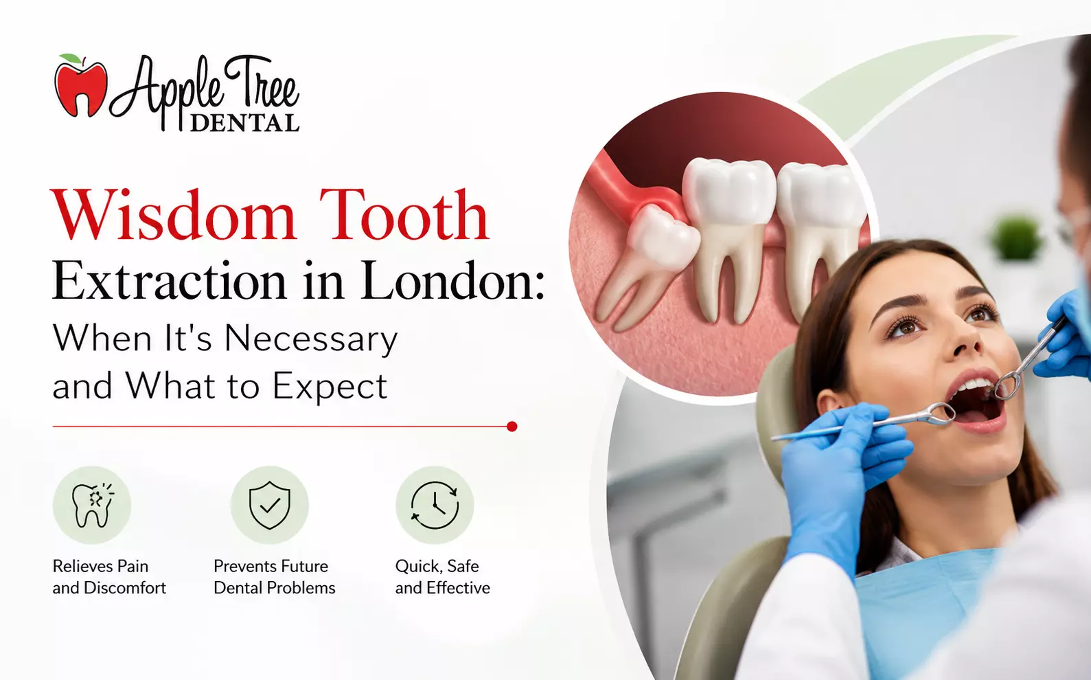Wisdom Tooth Extraction in London: When It's Necessary and What to Expect