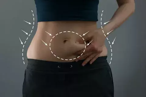Tummy Tuck in Dubai: Medical Excellence in Abdominal Reshaping