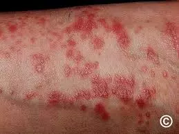 How to Reduce Lichen Planus Symptoms Naturally