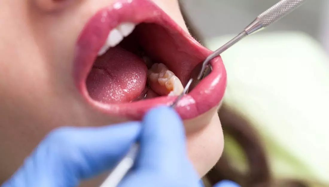 How to Care for Your Mouth After Tooth Removal