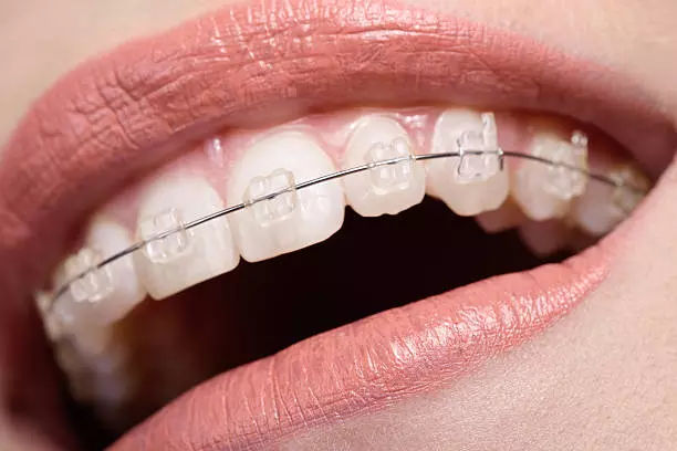 Achieve a Perfect Smile with Teeth Braces in Islamabad