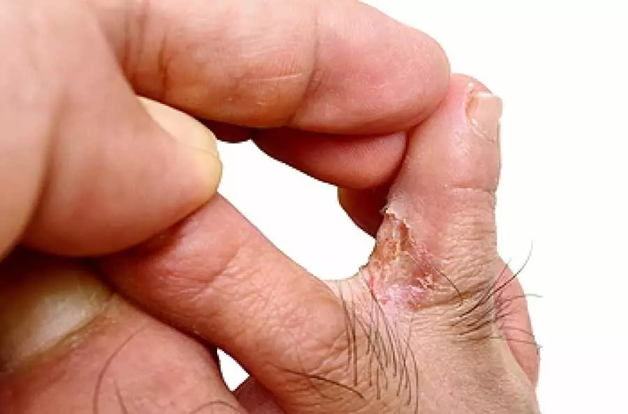 Eczema and Athlete’s Foot: Causes, Symptoms, and Effective Treatments