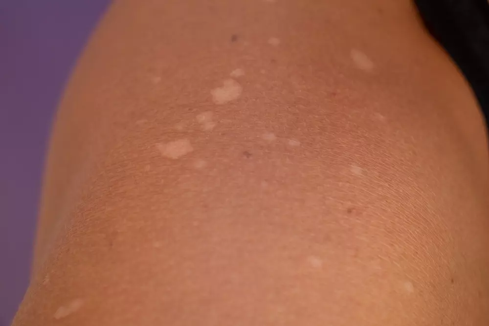 White Spots on Skin After Sun: Vitiligo or Something Else?