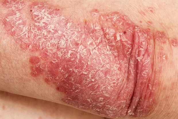 Finding the Best Dermatologist for Psoriasis Care