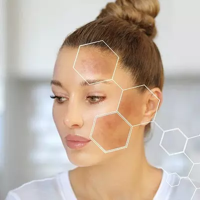 What to Expect in Your Follow-Up Visits for Melasma Treatment in Islamabad