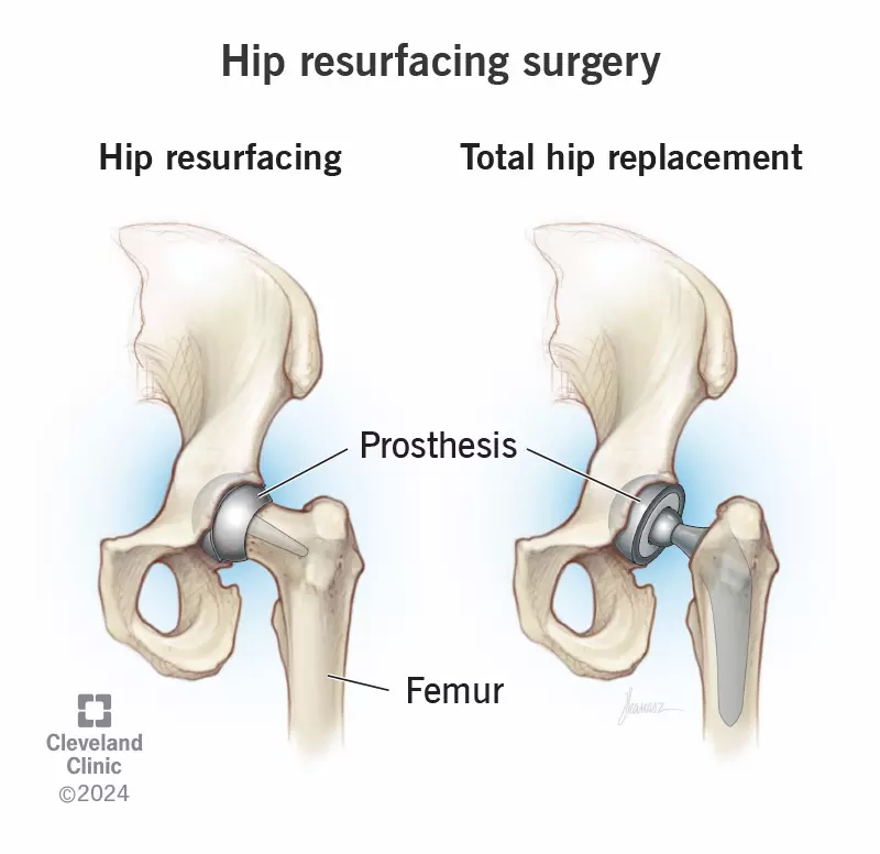 Hip Resurfacing vs Hip Replacement: Key Differences