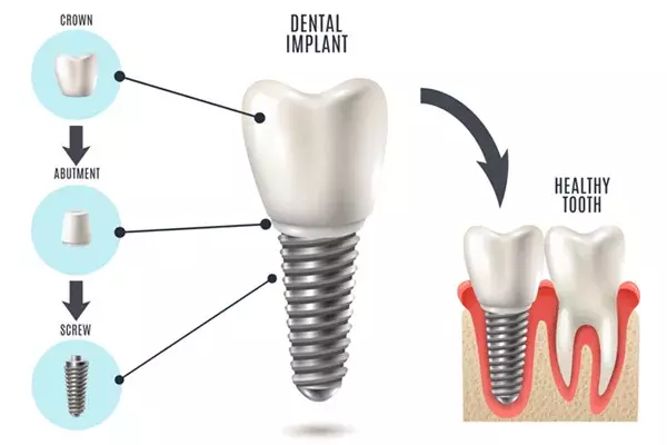 All on 4 Implants In Ashford: Your Complete Guide to a Full Smile Restoration