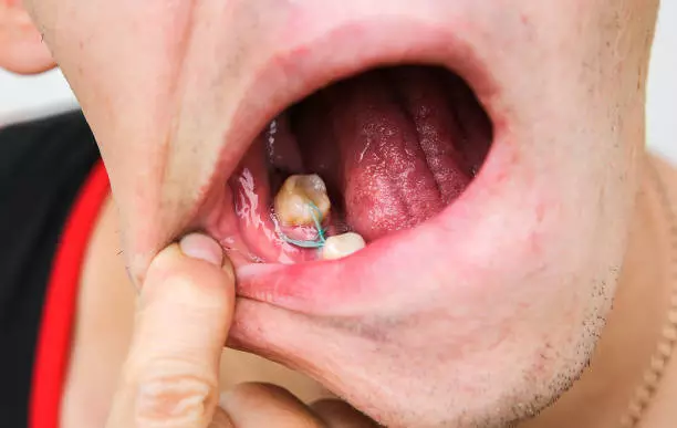 Gum Grafting in Islamabad: Improve Gum Health and Protect Your Teeth