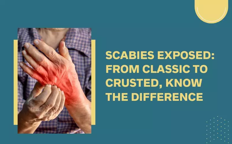 Scabies Recovery Timeline: What to Expect After Treatment