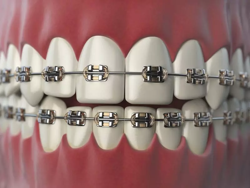 Dental Braces: Benefits, Types & Treatment Guide