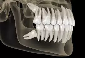 Top Tips for Fast Wisdom Teeth Pain Relief at Home