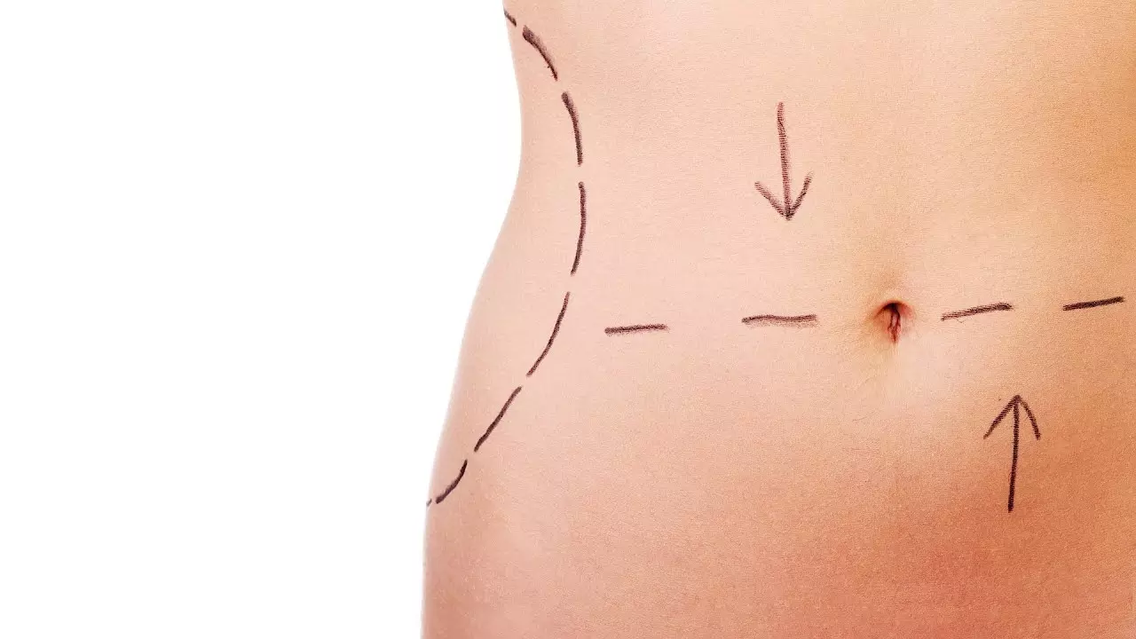 Combining Liposuction with Tummy Tuck in Islamabad for Moms