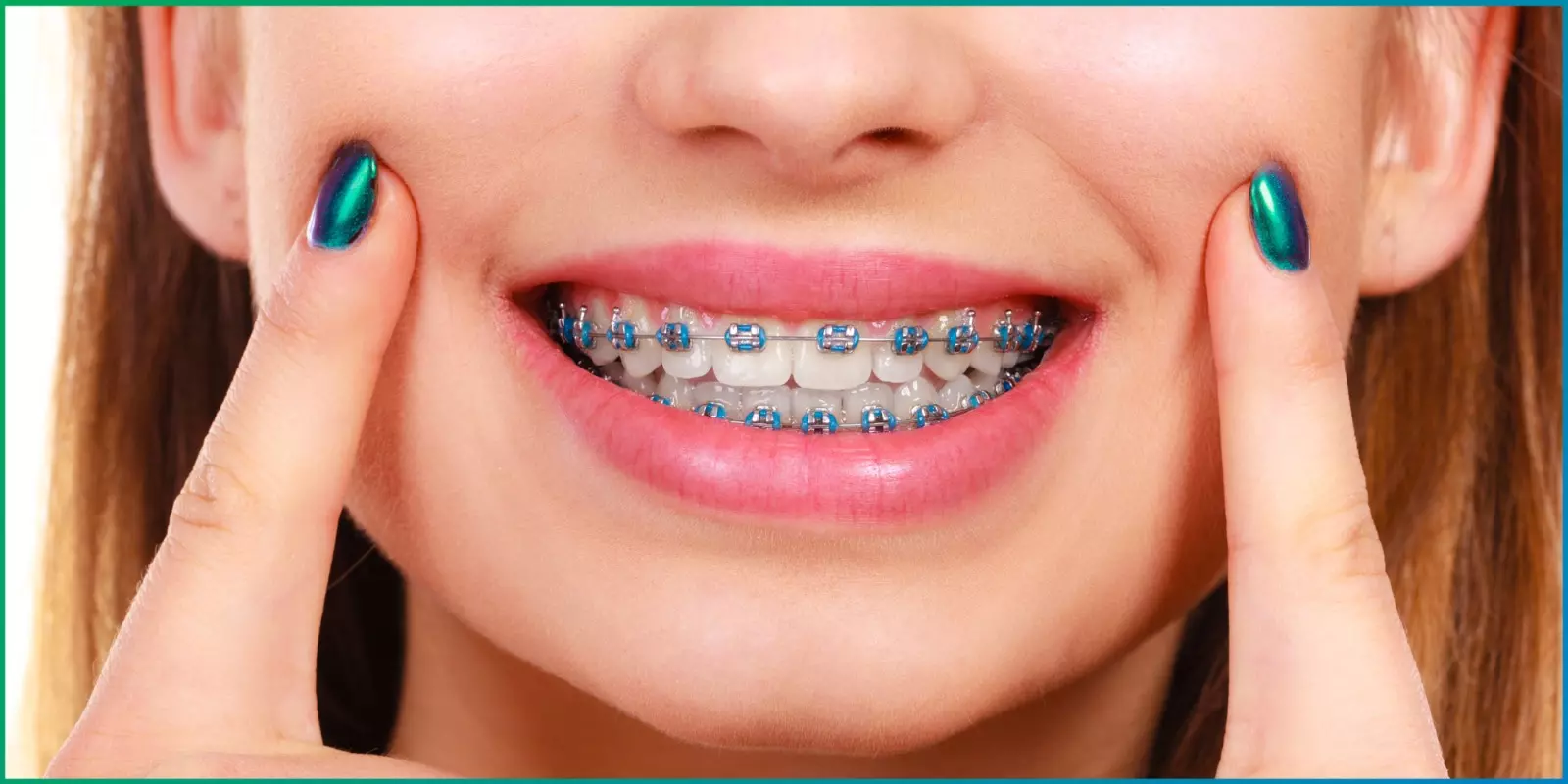 Top Dental Braces in Pune with Expert Orthodontic Care Services