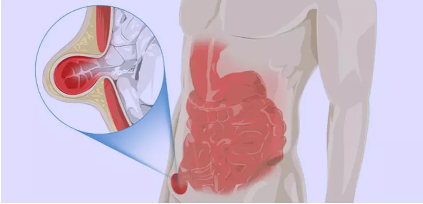 Hernia Signs You Shouldn’t Ignore: When Surgery Becomes Necessary