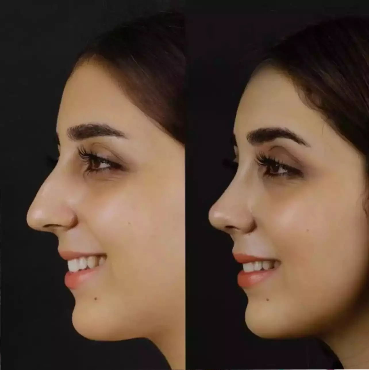Best Doctors in Dubai for Safe and Subtle Rhinoplasty Results