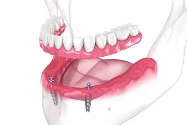 Dental Implants Oakville: Natural-Looking Tooth Replacement Options