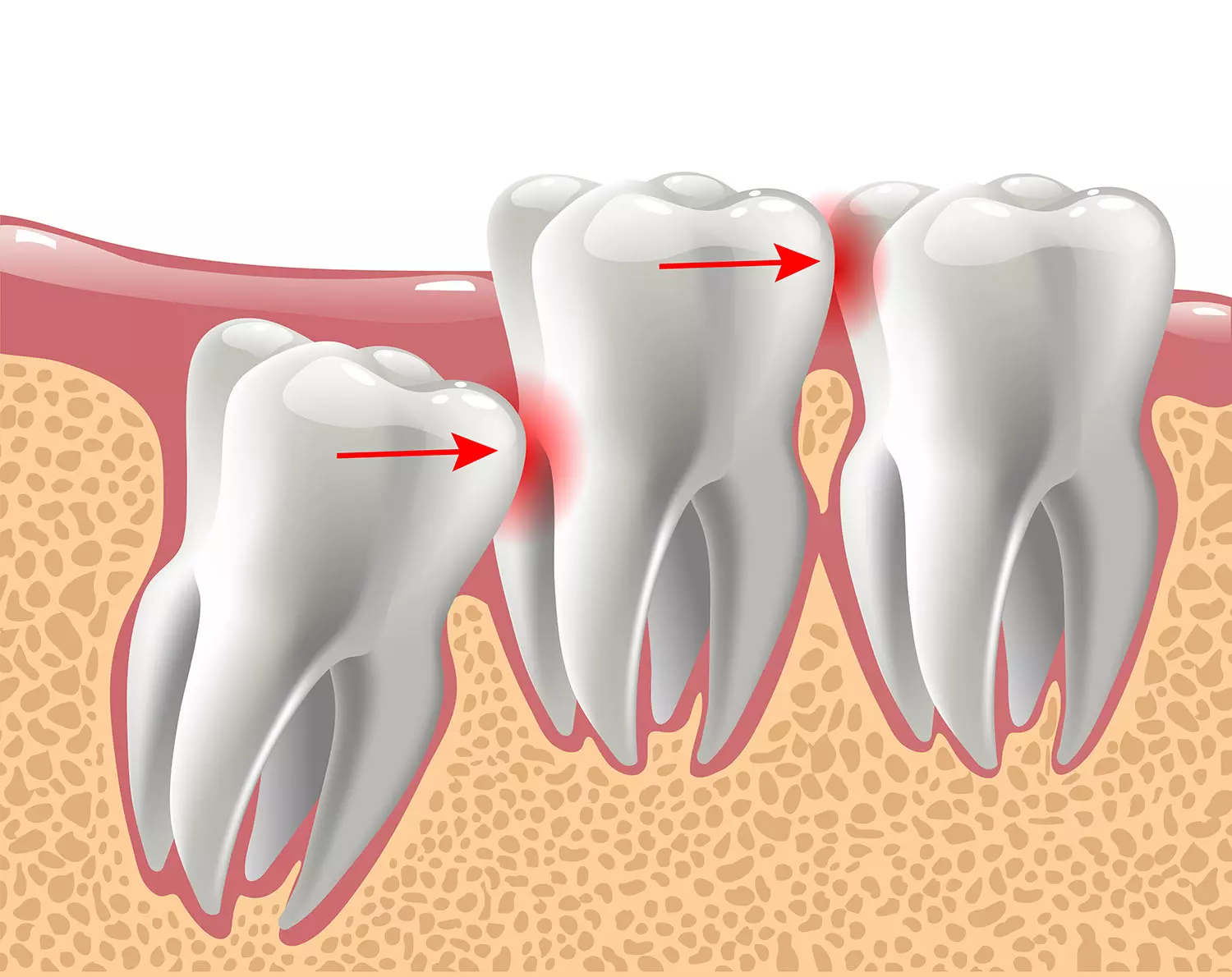 Navigating Wisdom Tooth Extraction in London: A Clinical Guide to Third Molars
