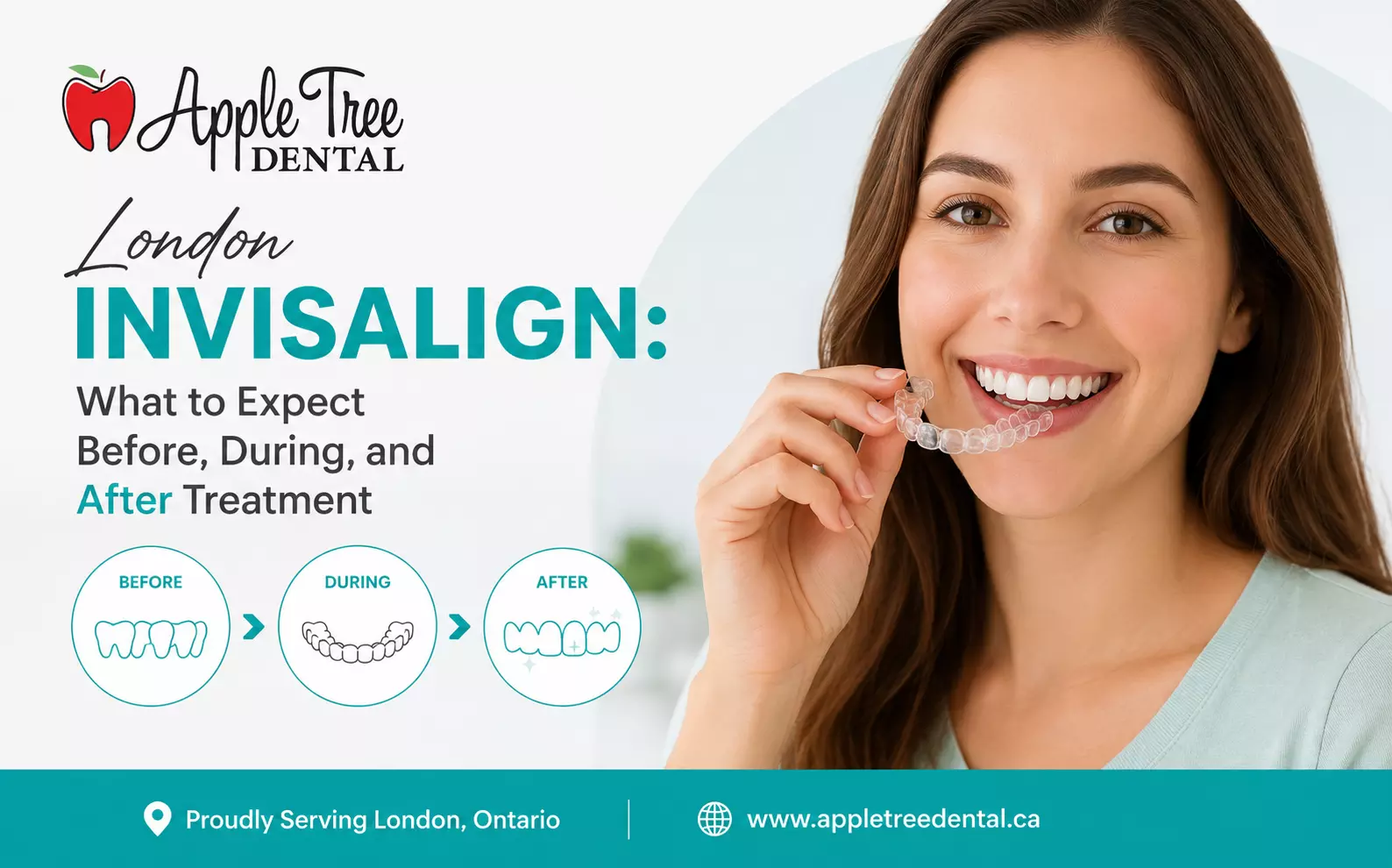 London Invisalign: What to Expect Before, During, and After Treatment