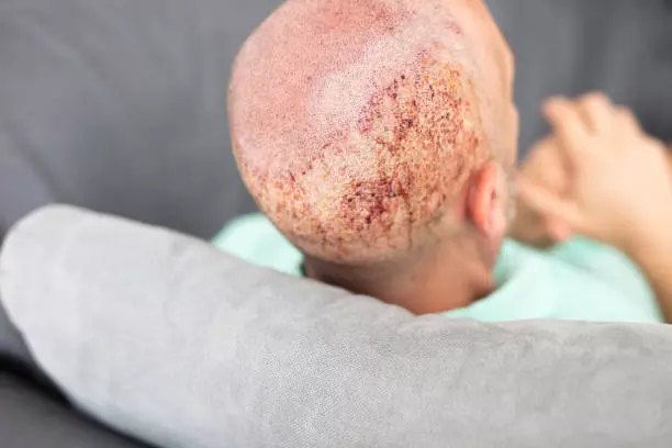 Can Exercise Affect Sideburn Hair Transplant Recovery?