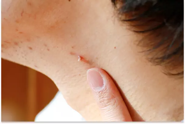 Understanding Skin Wart Removal and Severity Levels