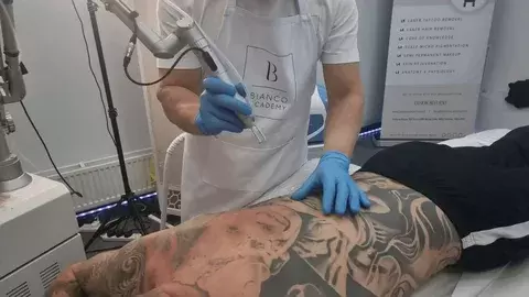 How Effective Is Laser Tattoo Removal in Dubai?