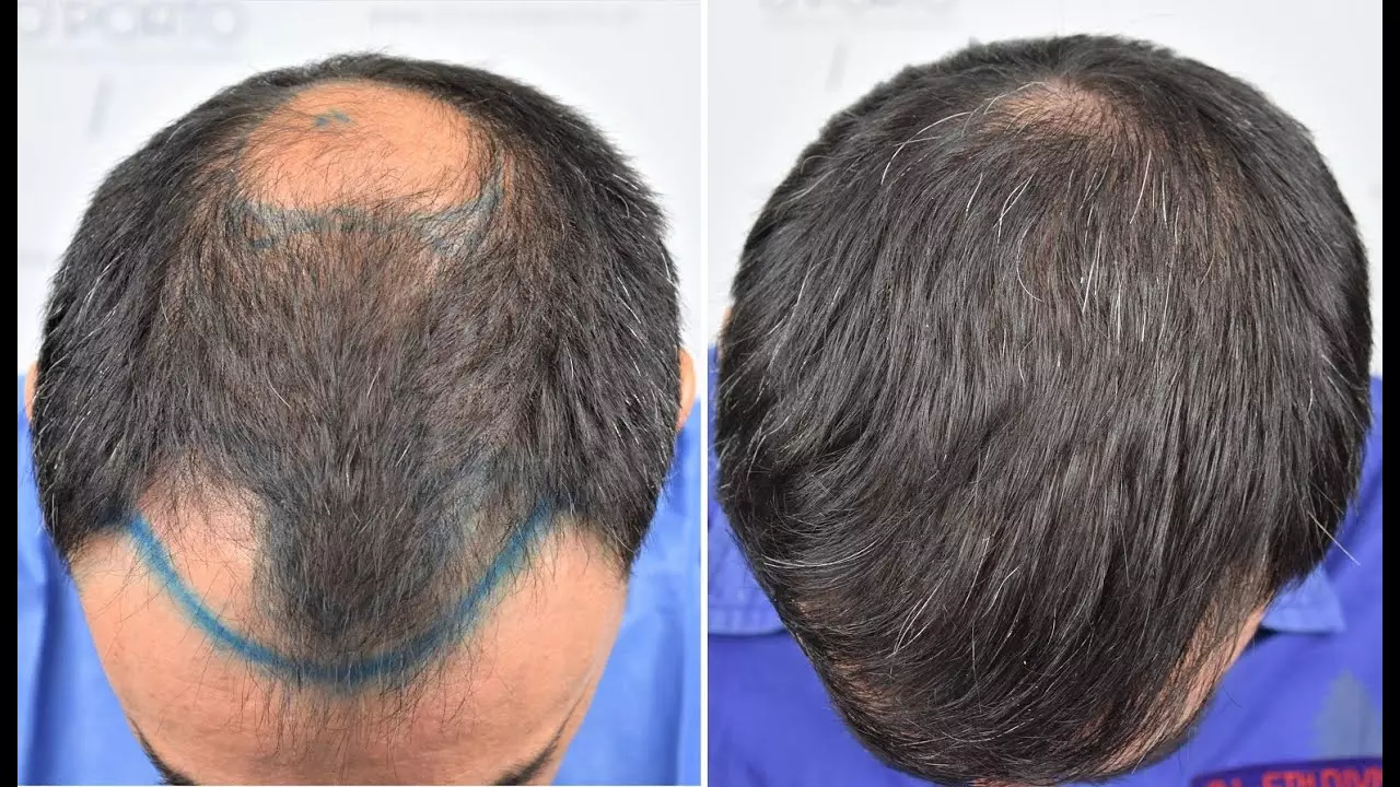 Crown Hair Density Calculations Before Transplant: A Crucial Step Toward Natural Results