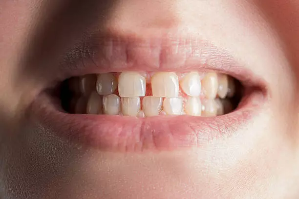 Advanced Dental Decision Guide for Patients Tooth Fracture Treatment in Pakistan: