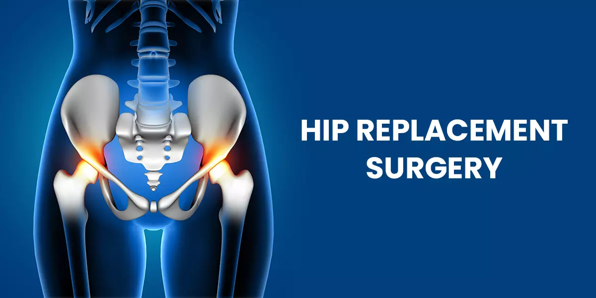 Hip Replacement Surgery Abroad: Step-by-Step Medical Travel Guide for Global Patients