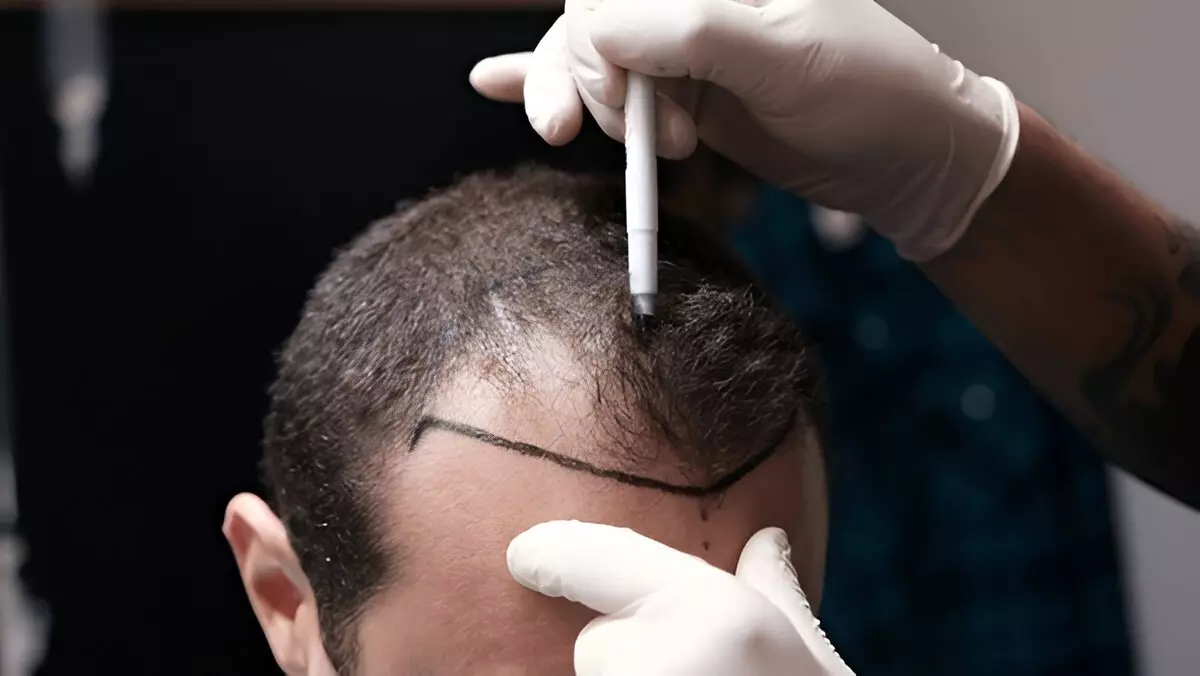 Top 10 Hair Transplant Surgeons in Gurgaon