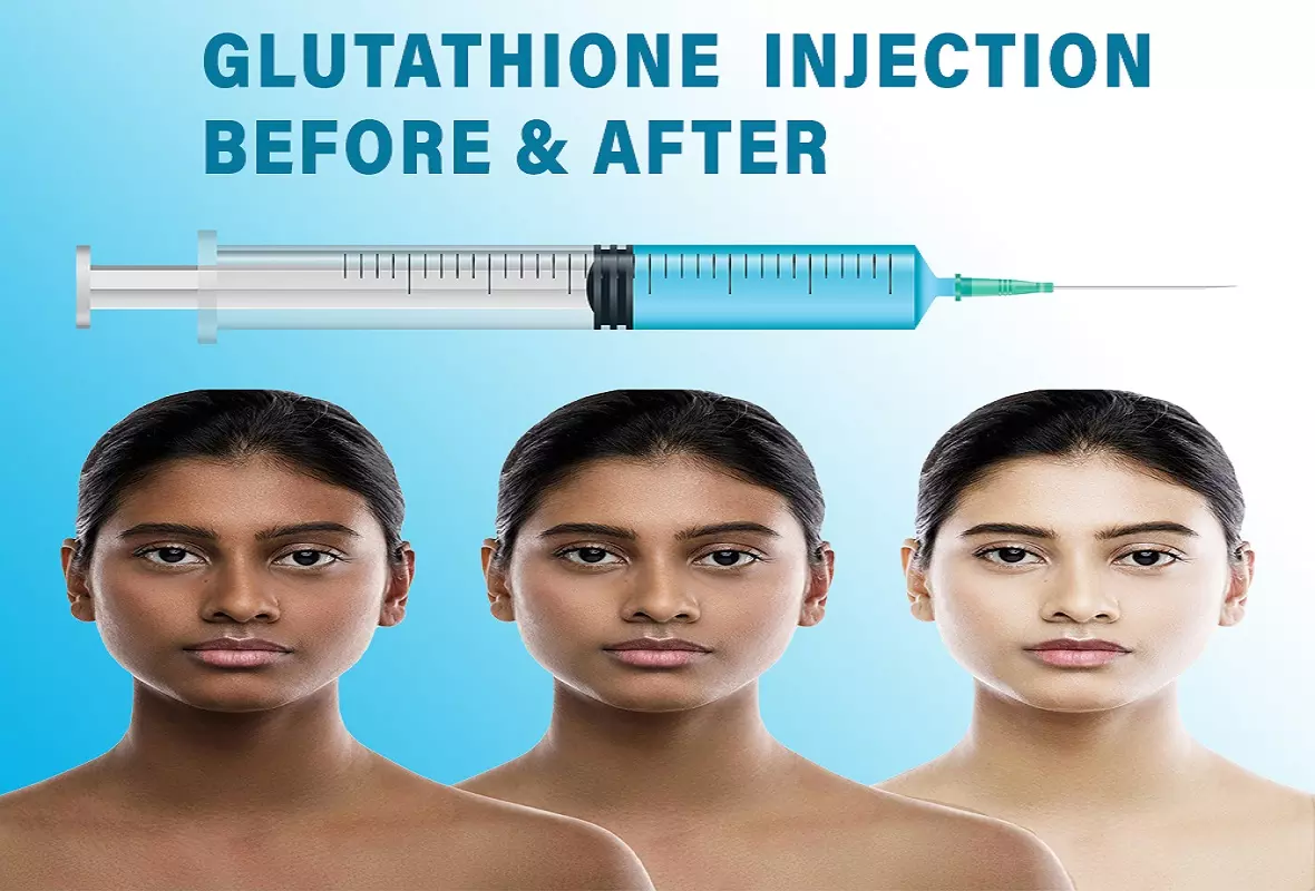How many glutathione injections should I take for skin whitening?