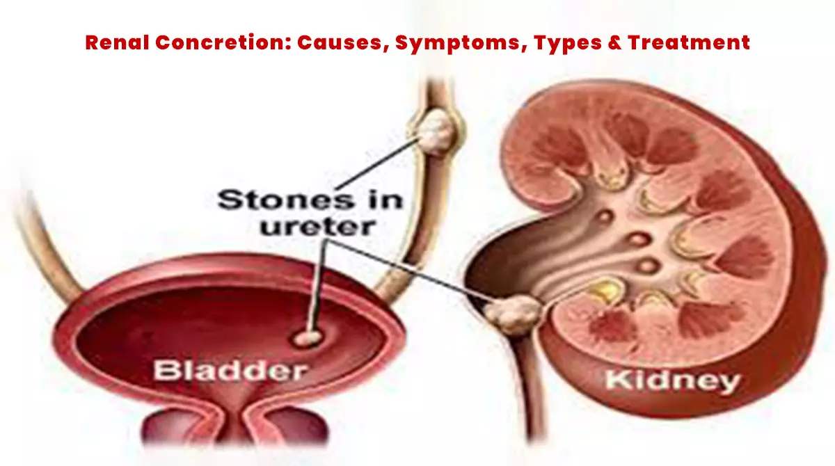 Renal Concretion: Causes, Symptoms, Types & Treatment