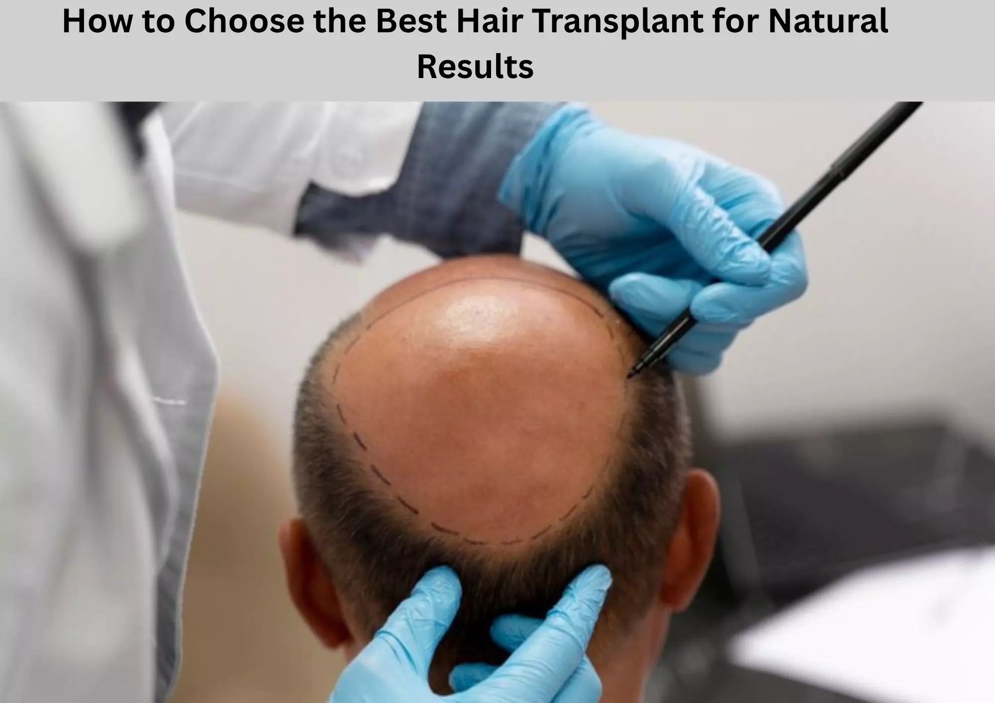 How to Choose the Best Hair Transplant for Natural Results