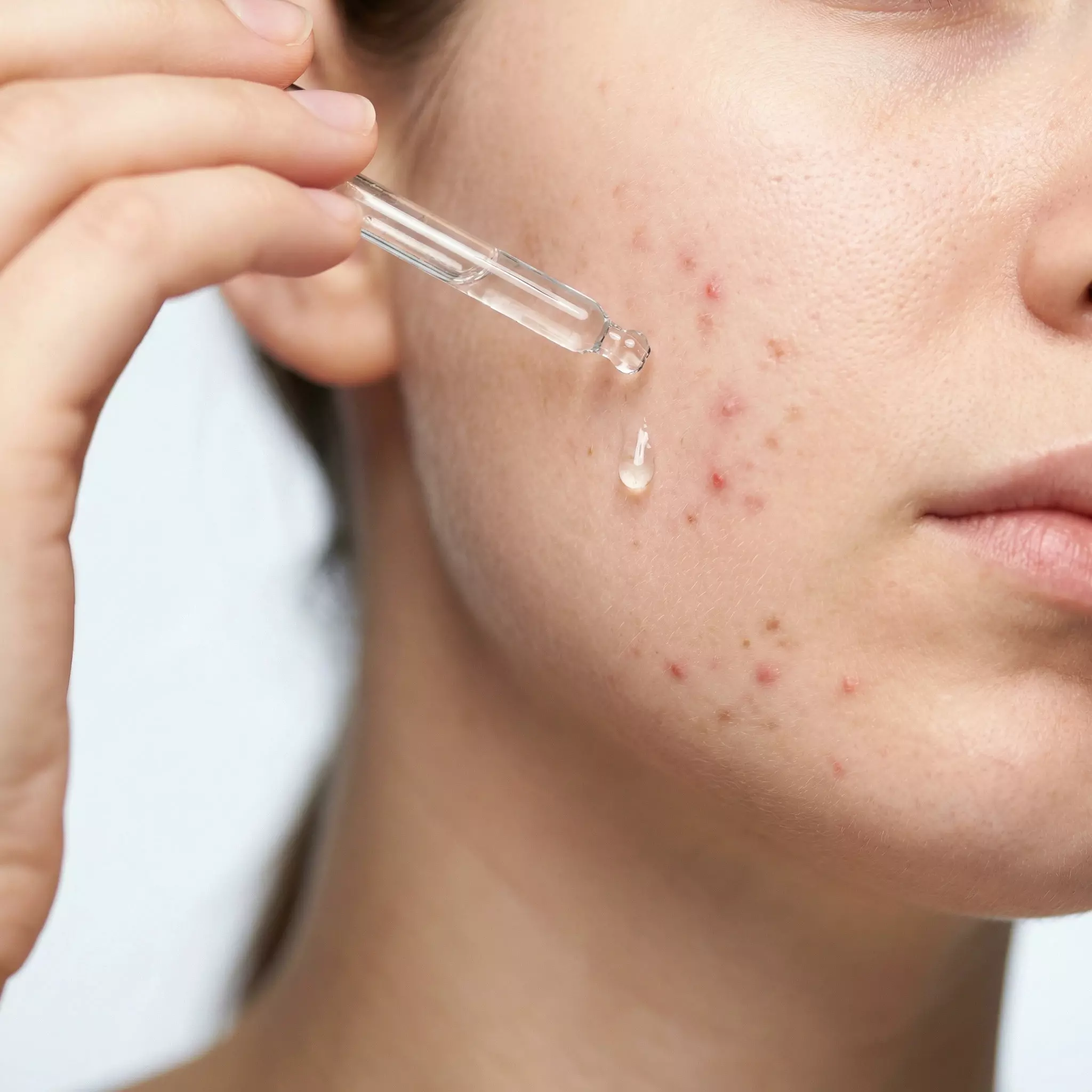 Acne Treatment in Melbourne, FL: A Complete Guide to Clearer, Healthier Skin