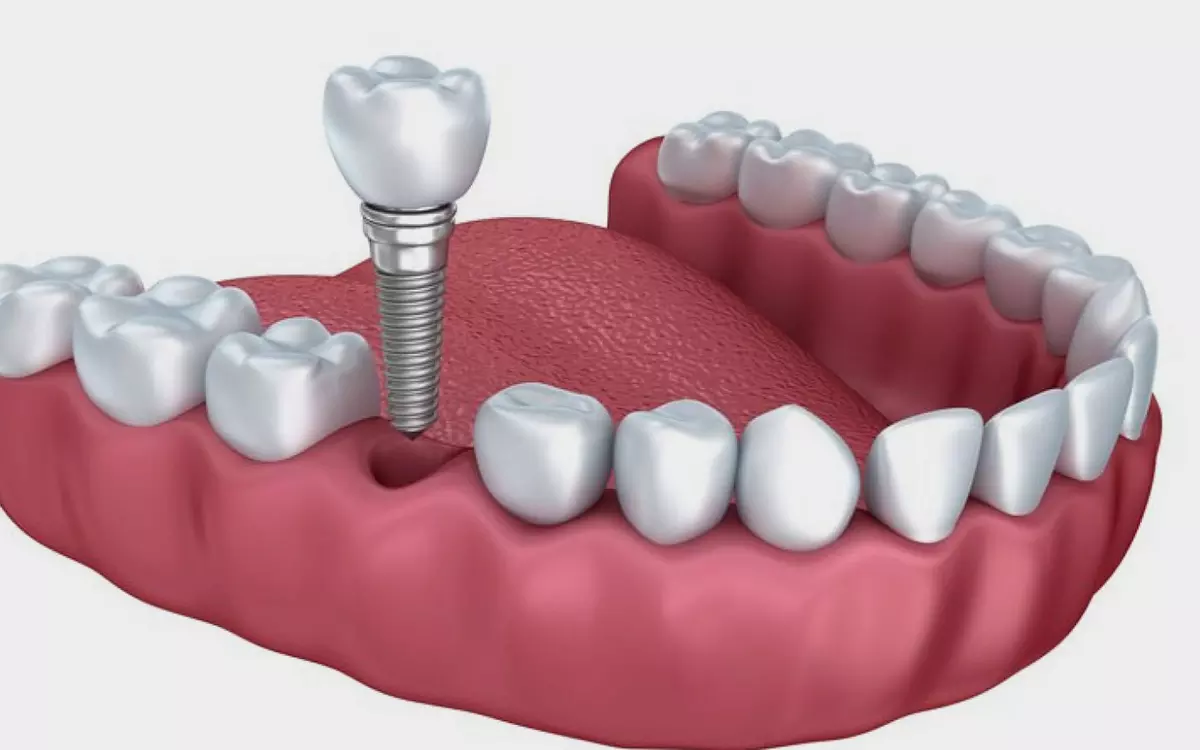 Root Canal Treatment in Panchkula: What to Expect